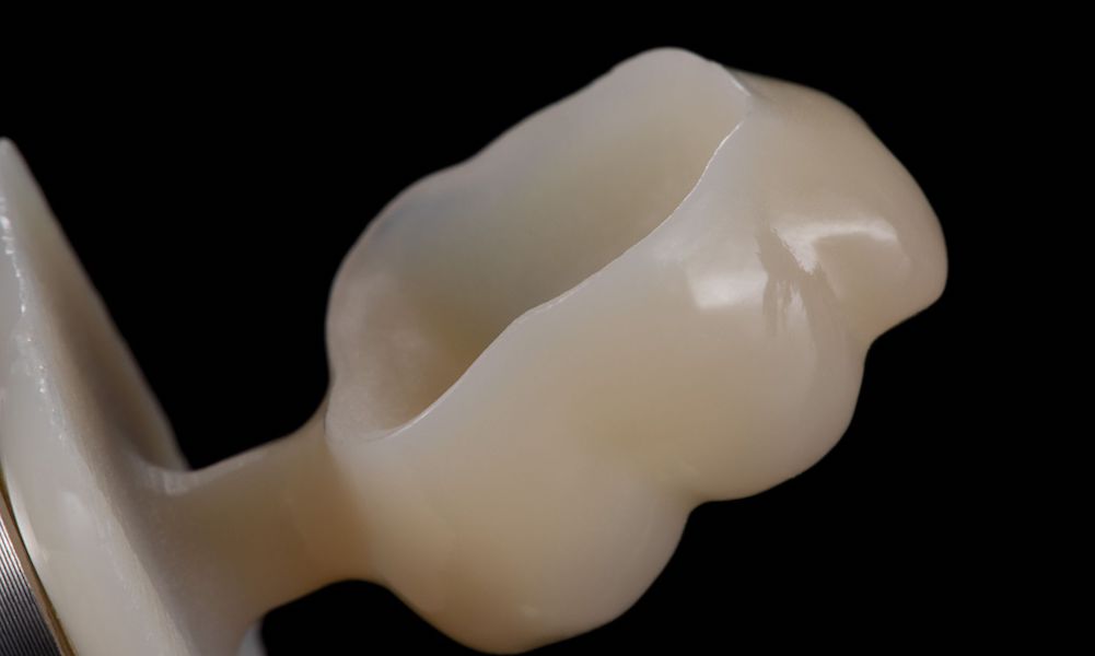 Dentale Keramiken im Fokus
